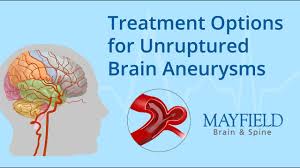 A brain aneurysm occurs when there is a bulge in a weakened blood vessel. Treatment Options For Unruptured Brain Aneurysms Youtube