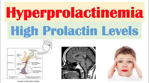 Image result for Hyperprolactinemia