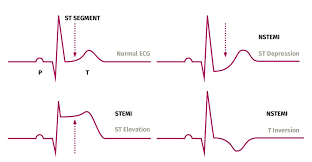 We did not find results for: Simon Wong åœ¨twitter ä¸Š An Nstemi Is A Type Of Heart Attack Nstemi Stands For Non St Elevation Myocardial Infarction An Nstemi Can Be Less Serious Than A Stemi This Is Because The Supply