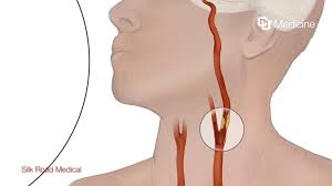 Image result for carotid artery