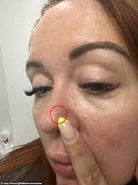 Image result for skin cancer on nose pimple