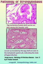 Image result for Strongyloides