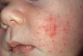 Avec ses boutons de fièvre connus de tous, l'herpès peut paraître presque commun. Dossier Les Boutons Chez L Enfant Comment Les Differencier Kangourou Kids