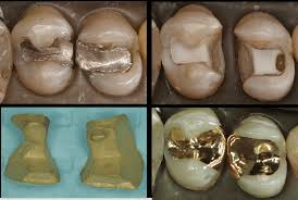 We did not find results for: Gold Restorations Cast And Foil December 4 6 2020 Stevenson Dental Solutions