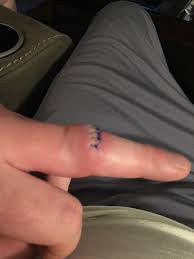 How long can you wait to get stitches on a cut? Are My Stitches Infected A Little Pain Swelling It S Been 9 Days Medical Advice