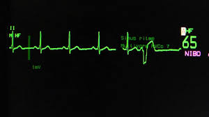 Image result for Extrasystole