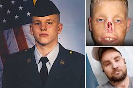 I had a full-face transplant — best decision I ever made