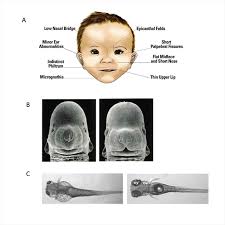 Advances In Diagnosis And Treatment Of Fetal Alcohol Spectrum Disorders From Animal Models To Human Studies Alcohol Research Current Reviews