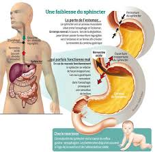 La progestérone, l'une des hormones sexuelles féminines, permet de décontracter les muscles lisses, pour éviter des contractions trop fortes qui seraient défavorables pour. Des Strategies Efficaces Contre Le Reflux Gastrique