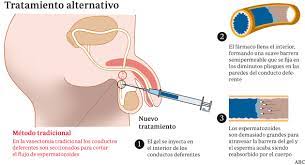 Últimamente, sin embargo, no se encontró un vínculo de prueba. Un Gel Inyectable La Alternativa A La Vasectomia Sin Cirugia