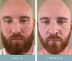 Image result for Seborrheic Dermatitis