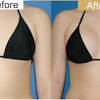 How much does breast enhancement cost. 1