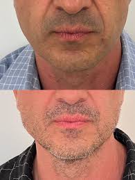 ✨Quando você se olha no espelho e sente que sua pele não tem mais a mesma  firmeza e contorno, isso mexe com a autoestima de qualquer pessoa!