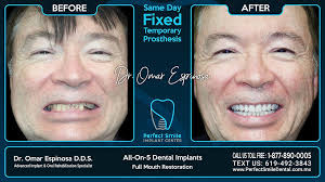 All-On-5 Dental Implants In Tijuana