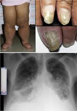 Image result for Yellow nail syndrome feet