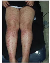 Burns, permanent changes to your skin color, and scars can occur. Numerous Palpable Purpura Over Both Thighs And Legs After Laser Hair Download Scientific Diagram