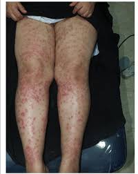 If you have botox or dermal fillers in the area to be treated, wait 14 days both before and after injection to receive treatments. Numerous Palpable Purpura Over Both Thighs And Legs After Laser Hair Download Scientific Diagram