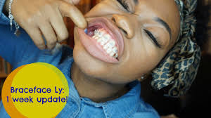 Maybe you would like to learn more about one of these? Braces 1 Week Update The Good The Bad And The Ugly Youtube