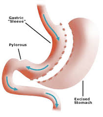 Read this before you sign up! Sleeve Gastrectomy Gastric Sleeve Complications Robert Brolin M D