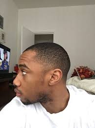 Hair transplant women hair transplant results fue hair transplant natural hair bun styles hair styles world hair anti hair loss hair loss women hair loss remedies more information. Fue Hair Transplant Black Afro African Caribbean Hair 1800 Grafts