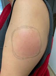 Mar 03, 2021 · moderna's coronavirus vaccine may cause alarming delayed side effects from its first dose among a portion of recipients. Moderna Vaccine Causing Covid Arm Among Some Patients Kfox