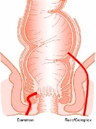 This external opening is usually easily detected. Perianal Abscess Fistula In Ano Causes Treatment Surgery Glasgow Colorectal Centre