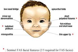 Physical examination identified a series of dysmorphic features, including epicanthal folds, a flat nasal bridge. Fetal Alcohol Spectrum Disorders Diagnostic Considerations For Children With A History Of Trauma Springerlink