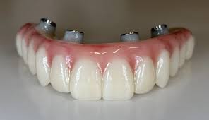 Image result for dental implant