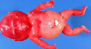 Pin By P Foster On Disease Illustrations Fetal Abnormalities Pictures Medical
