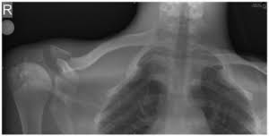 Image result for SC Dislocation