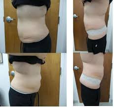 Sculpsure Laser Liposuction Before After Photos Winston Salem Nc Winston Salem Carolina Laser And Cosmetic Center D Sculpsure Sculpsure Laser Laser Liposuction