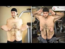 Loose Skin Fit Life Body Contouring