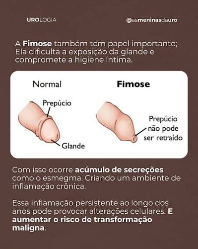 O câncer de pênis é raro no mundo, mas ainda preocupa no Brasil. Muitos casos estão relacionados principalmente a higiene inadequada. O principal sinal de alerta são feridas ou lesões que não