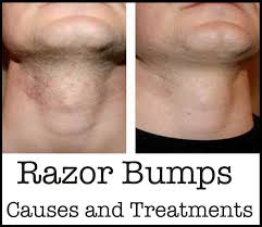 Men with curly hair are 50 times more likely than those with straight hair to suffer from ingrown hairs. Razor Bumps Causes And Treatments Razor Burns Straight Razor Shaving Razor Bumps
