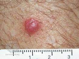The 4 stages of melanoma: Skin Cancer Image Gallery Pictures And Photos