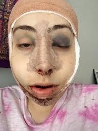 She is an amazing transgender model from bangkok, thailand. My Facial Feminization Story The Complex Process Of Ffs Surgery Allure