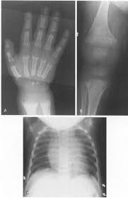 Imaging Of Metabolic Bone Disease And Marrow Disorders In Children Radiologic Clinics