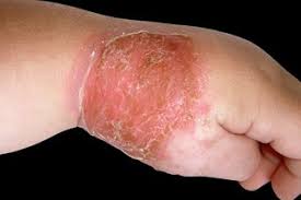 After wetting your hands and adding soap, scrub your hands for at least 20 seconds. Staph Infection Nhs