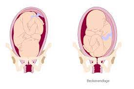 Etwa fünf prozent aller babys liegen am errechneten geburtstermin in der beckenendlage. Beckenendlage Wenn Sich Das Baby Nicht Drehen Will