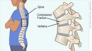 Inside look/diagram of rear brake drums Vertebral Compression Fractures Advanced Pain Management Center Interventional Pain Management Physician