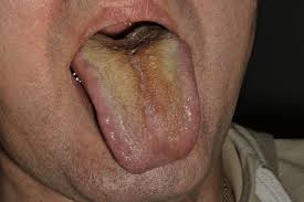 Image result for yellow tongue infection