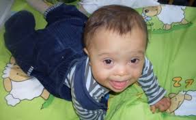 There are three types of down syndrome. Durch Pranatale Tests 30 Prozent Weniger Geburten Von Babys Mit Downsyndrom