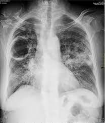 Tb Cavity Radiology Imaging Radiology Medical Pictures