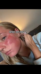 How to Fix A Red Bump from Sunburnt