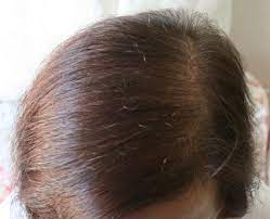 Hallo allerseits, dies ist mein erster (und vermutlich auch letzter beitrag) bzgl. Forum Haarausfall Frauen Forum Frauen Meine Haartransplantation