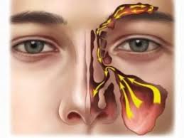 sinusitis ile ilgili görsel sonucu