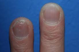 Image result for Nail Pitting