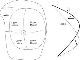 Breast shape varies among patients, but knowing and understanding the anatomy of the breast ensures safe surgical planning. Breast Shape Changes During Radiation Therapy After Breast Conserving Surgery Sciencedirect