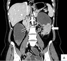 A ct scan may see irregularities in the liver that may be malignant. A Case Of Progressive Abdominal Pain Leads To A Surprise Finding Medpage Today