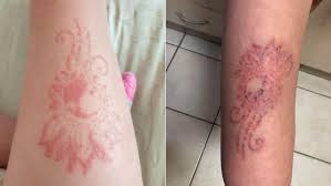 Tattoos can cause localized skin reactions such as allergic reactions to the dye or lichenoid (appear like lichen) skin infections. Sydney Girl Left Nursing Painful Infection After Receiving Dodgy Henna Tattoo In Bali 7news Com Au